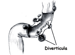 diverticulosis picture