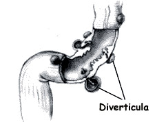 diverticulosis picture diverticulosis picture