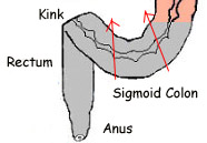 sigmoid colon, kink in sigmoid colon