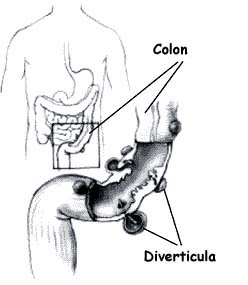 diverticulitis picture, diverticulosis picture