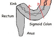 sigmoid colon sigmoid colon