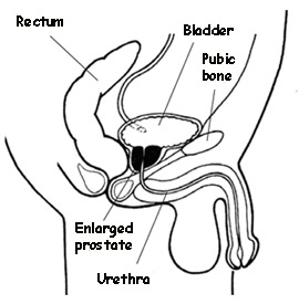 swollen prostate, enlarged prostate, bph